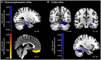 Loss of control eating in children is associated with altered cortical and subcortical brain structure